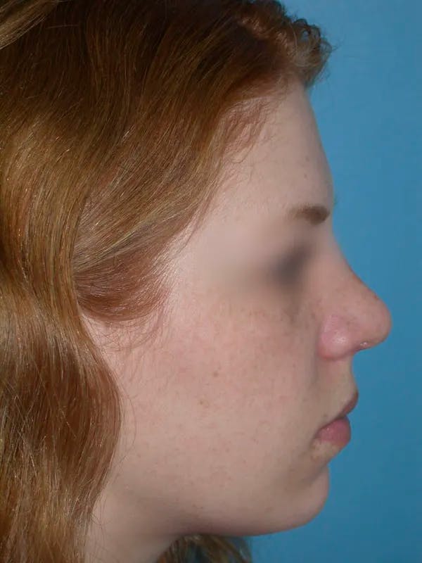 Rhinoplasty Before & After Gallery - Patient 4757187 - Image 1