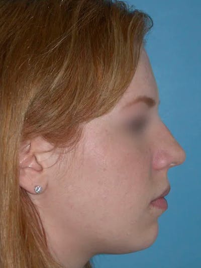Rhinoplasty Gallery Before & After Gallery - Patient 4757187 - Image 2