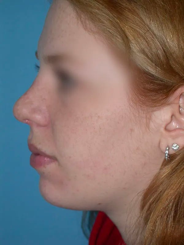 Rhinoplasty Gallery Before & After Gallery - Patient 4757187 - Image 3