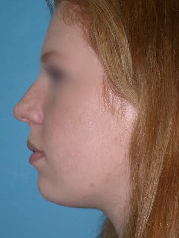 Rhinoplasty Before & After Gallery - Patient 4757187 - Image 4