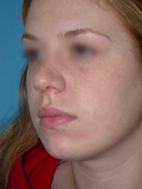 Rhinoplasty Before & After Gallery - Patient 4757187 - Image 5