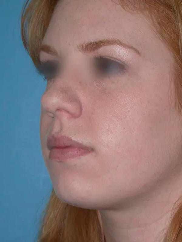 Rhinoplasty Before & After Gallery - Patient 4757187 - Image 6