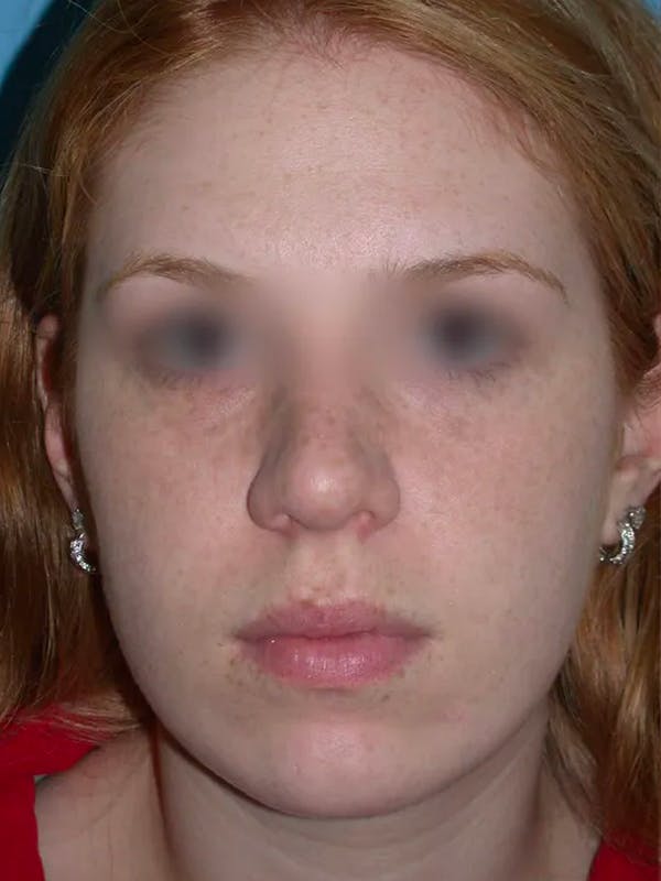 Rhinoplasty Before & After Gallery - Patient 4757187 - Image 7
