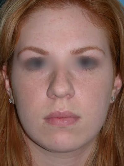 Rhinoplasty Gallery Before & After Gallery - Patient 4757187 - Image 8