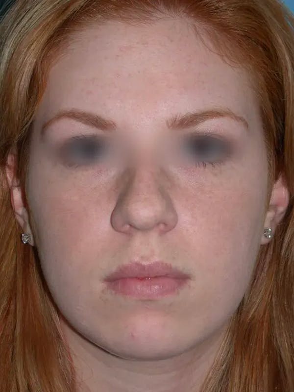 Rhinoplasty Gallery Before & After Gallery - Patient 4757187 - Image 8