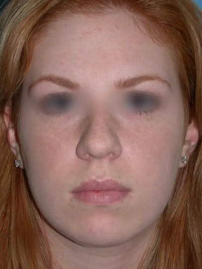 Rhinoplasty Before & After Gallery - Patient 4757187 - Image 8