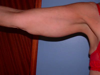 Arm Lift Before & After Gallery - Patient 4752087 - Image 1