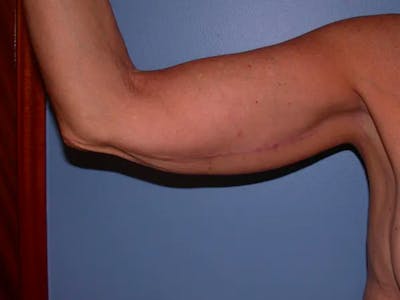 Arm Lift Gallery Before & After Gallery - Patient 4752087 - Image 2