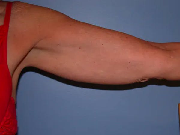 Arm Lift Gallery Before & After Gallery - Patient 4752087 - Image 3