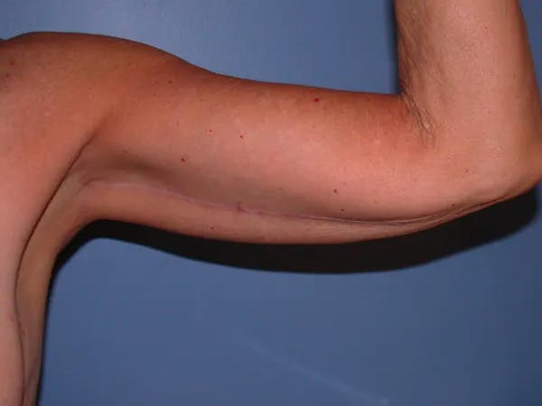 Arm Lift Gallery Before & After Gallery - Patient 4752087 - Image 4