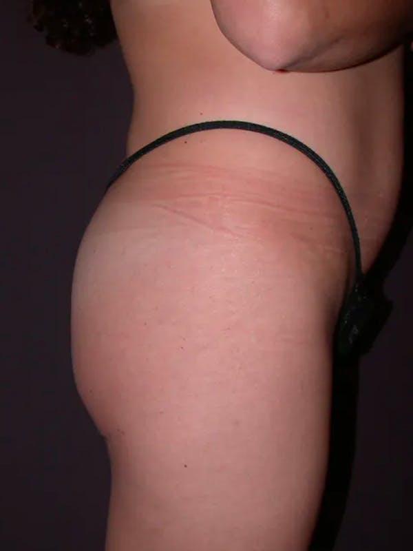 Brazilian Butt Lift Before & After Gallery - Patient 54027004 - Image 3