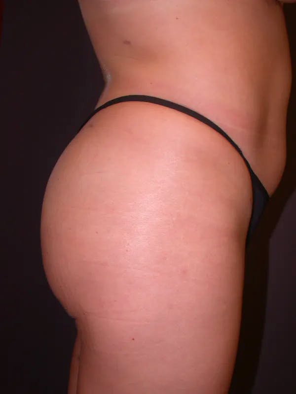 Brazilian Butt Lift Gallery Before & After Gallery - Patient 54027004 - Image 4