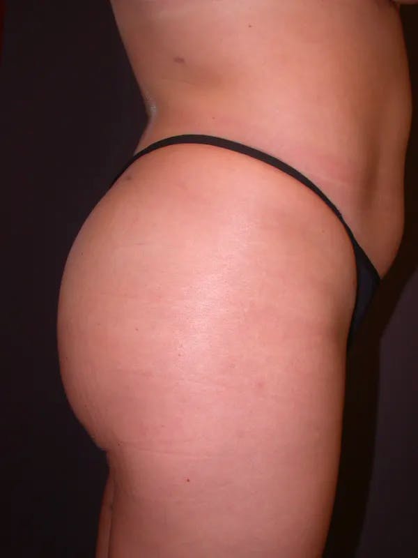 Brazilian Butt Lift Before & After Gallery - Patient 54027004 - Image 4