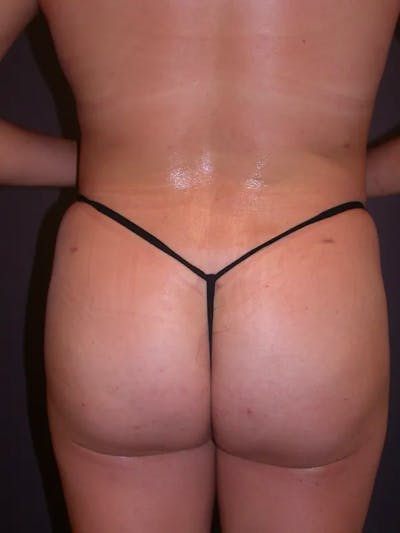 Brazilian Butt Lift Gallery Before & After Gallery - Patient 54027004 - Image 6