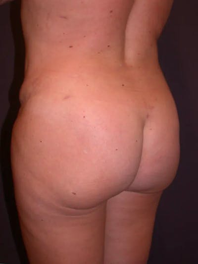 Brazilian Butt Lift Gallery Before & After Gallery - Patient 4752159 - Image 2