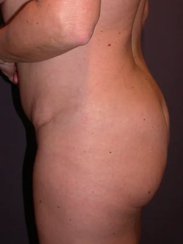 Brazilian Butt Lift Gallery Before & After Gallery - Patient 4752159 - Image 3