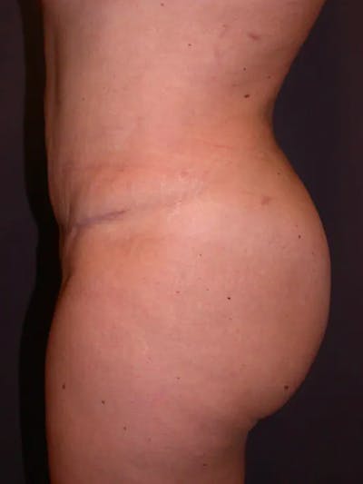 Brazilian Butt Lift Gallery Before & After Gallery - Patient 4752159 - Image 4