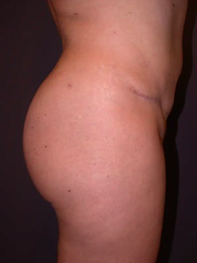 Brazilian Butt Lift Gallery Before & After Gallery - Patient 4752159 - Image 6