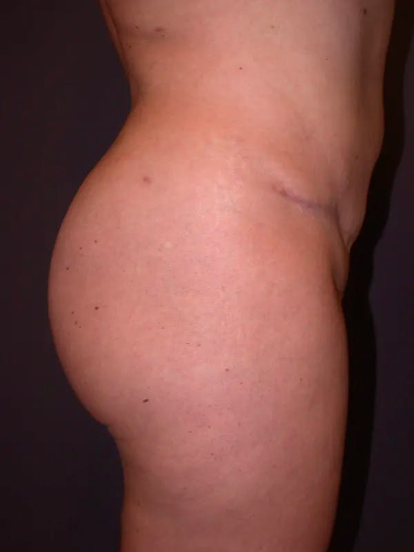 Brazilian Butt Lift Gallery Before & After Gallery - Patient 4752159 - Image 6