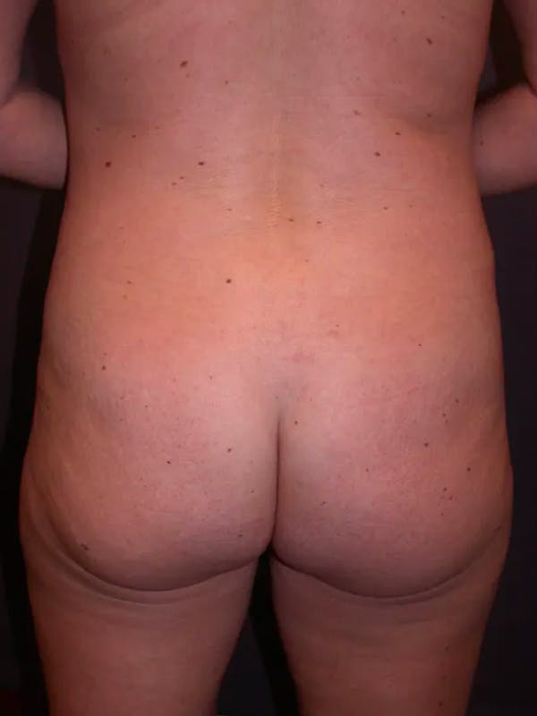 Brazilian Butt Lift Gallery Before & After Gallery - Patient 4752159 - Image 7