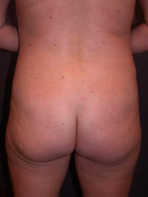 Brazilian Butt Lift Gallery - Patient 4752159 - Image 7