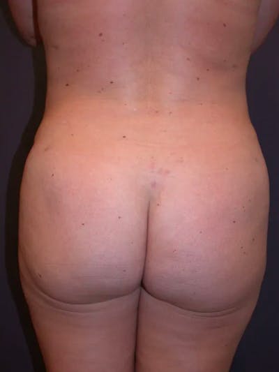 Brazilian Butt Lift Gallery Before & After Gallery - Patient 4752159 - Image 8