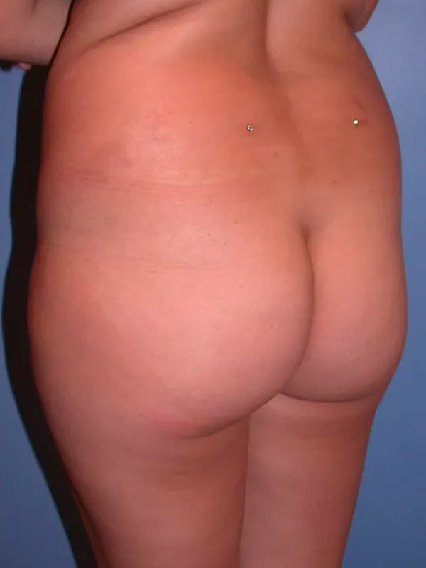 Brazilian Butt Lift Before & After Gallery - Patient 4752153 - Image 1