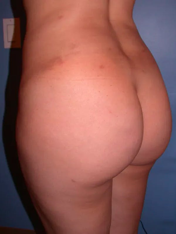 Brazilian Butt Lift Before & After Gallery - Patient 4752153 - Image 2