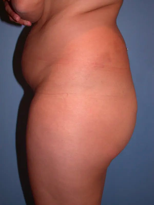 Brazilian Butt Lift Gallery Before & After Gallery - Patient 4752153 - Image 3