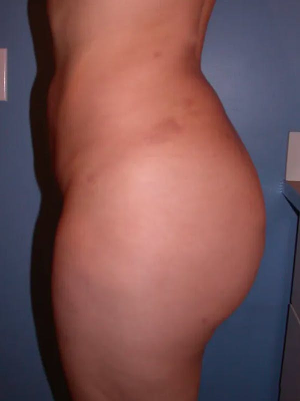 Brazilian Butt Lift Gallery Before & After Gallery - Patient 4752153 - Image 4
