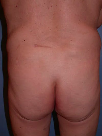 Brazilian Butt Lift Before & After Gallery - Patient 4752160 - Image 1