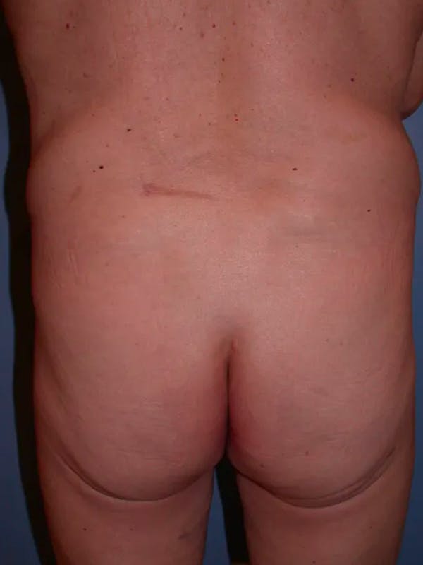 Brazilian Butt Lift Gallery - Patient 4752160 - Image 1