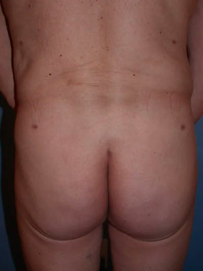 Brazilian Butt Lift Gallery Before & After Gallery - Patient 4752160 - Image 2