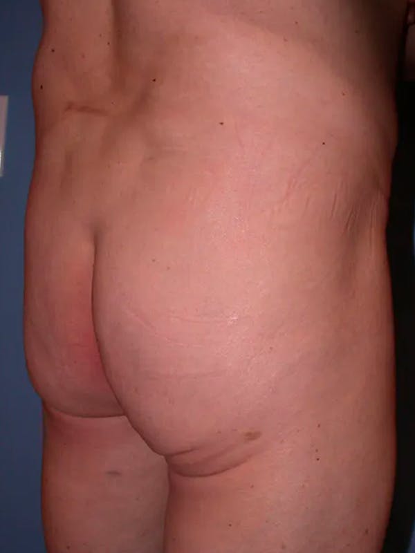 Brazilian Butt Lift Gallery Before & After Gallery - Patient 4752160 - Image 3