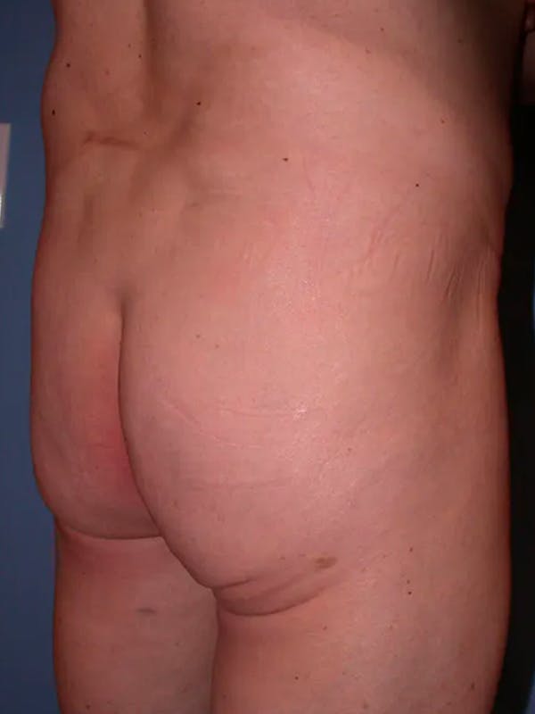 Brazilian Butt Lift Gallery - Patient 4752160 - Image 3