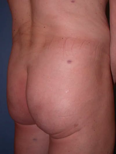 Brazilian Butt Lift Gallery Before & After Gallery - Patient 4752160 - Image 4