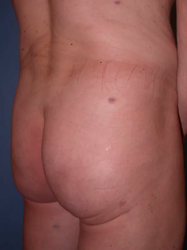 Brazilian Butt Lift Gallery Before & After Gallery - Patient 4752160 - Image 4