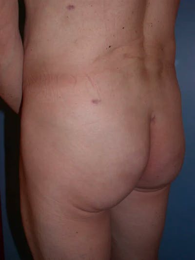 Brazilian Butt Lift Gallery Before & After Gallery - Patient 4752160 - Image 6