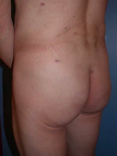 Brazilian Butt Lift Gallery - Patient 4752160 - Image 6