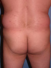 Brazilian Butt Lift Gallery Before & After Gallery - Patient 4752161 - Image 1