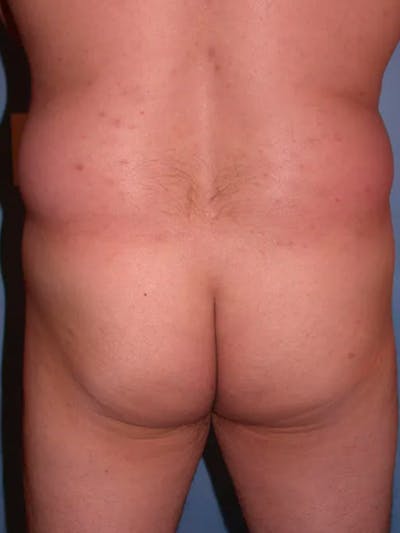 Brazilian Butt Lift Before & After Gallery - Patient 4752161 - Image 1