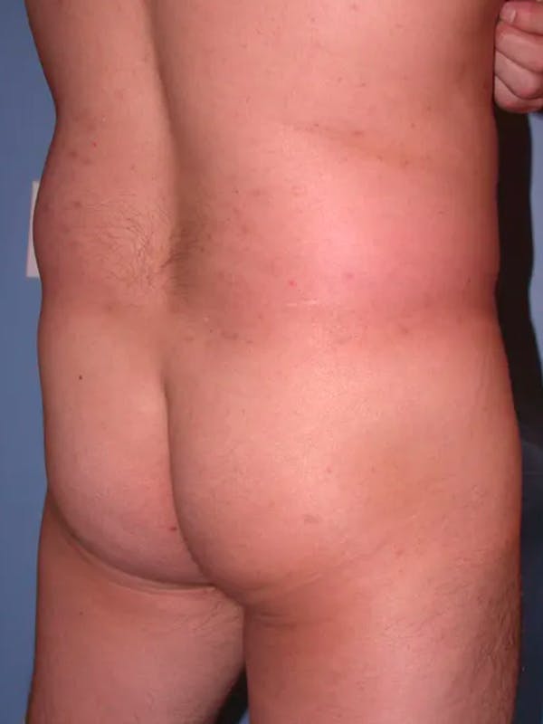 Brazilian Butt Lift Gallery Before & After Gallery - Patient 4752161 - Image 3
