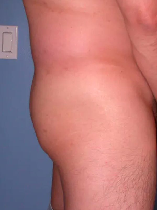 Brazilian Butt Lift Gallery Before & After Gallery - Patient 4752161 - Image 5