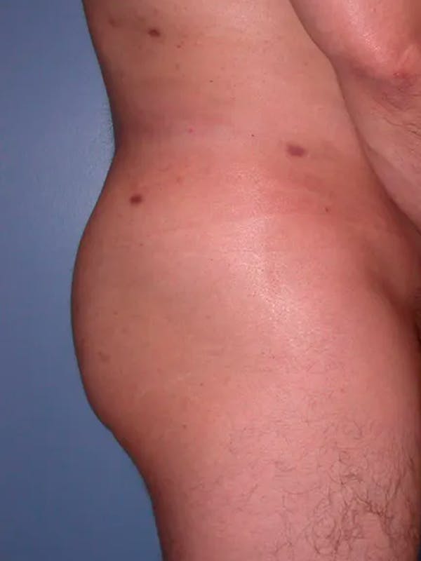 Brazilian Butt Lift Gallery Before & After Gallery - Patient 4752161 - Image 6