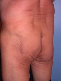 Brazilian Butt Lift Gallery Before & After Gallery - Patient 4752165 - Image 1