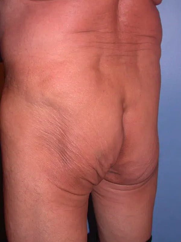 Brazilian Butt Lift Gallery - Patient 4752165 - Image 1