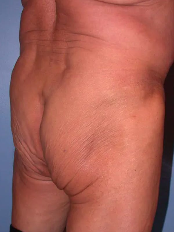 Brazilian Butt Lift Gallery Before & After Gallery - Patient 4752165 - Image 3