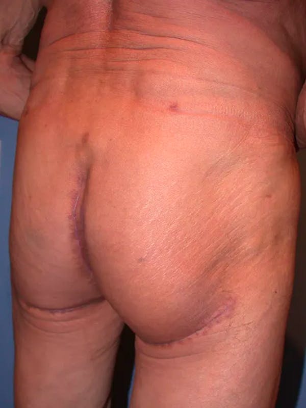 Brazilian Butt Lift Gallery Before & After Gallery - Patient 4752165 - Image 4