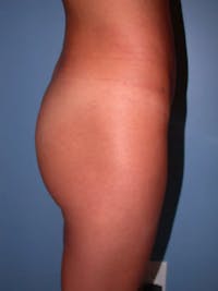 Brazilian Butt Lift Gallery Before & After Gallery - Patient 4752150 - Image 1