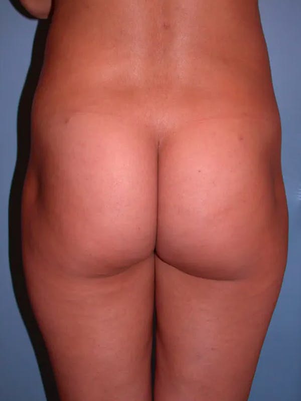 Brazilian Butt Lift Gallery Before & After Gallery - Patient 4752150 - Image 3